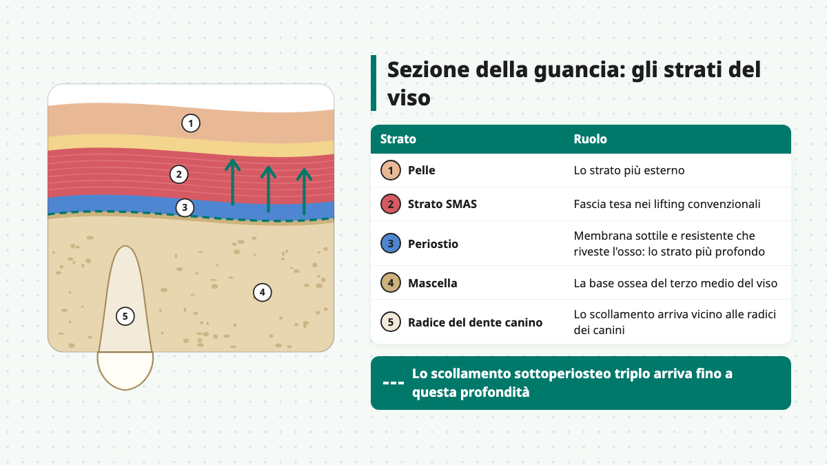 Sezione trasversale della guancia con pelle, strato SMAS, periostio, mascella e radice del dente canino