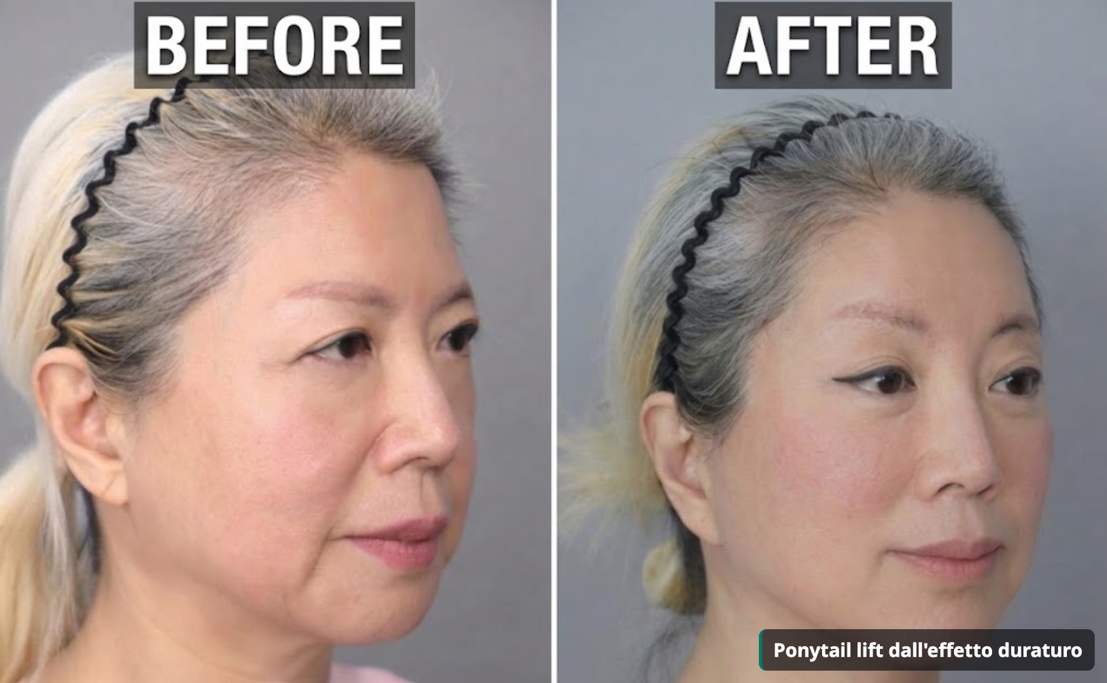 Prima e dopo il ponytail lift con scollamento sottoperiosteo triplo
